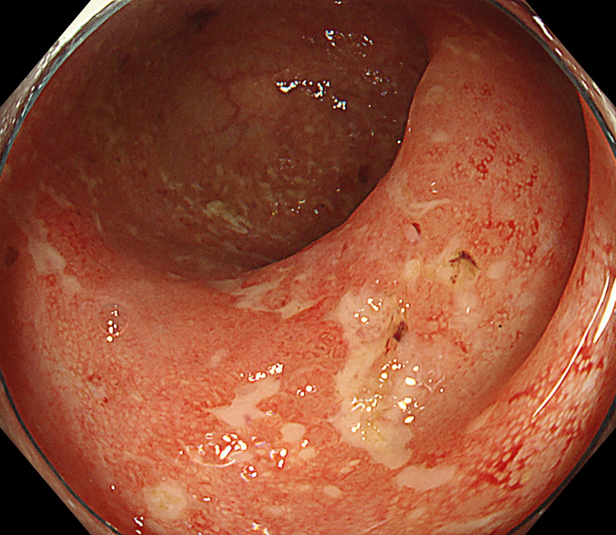 潰瘍性大腸炎