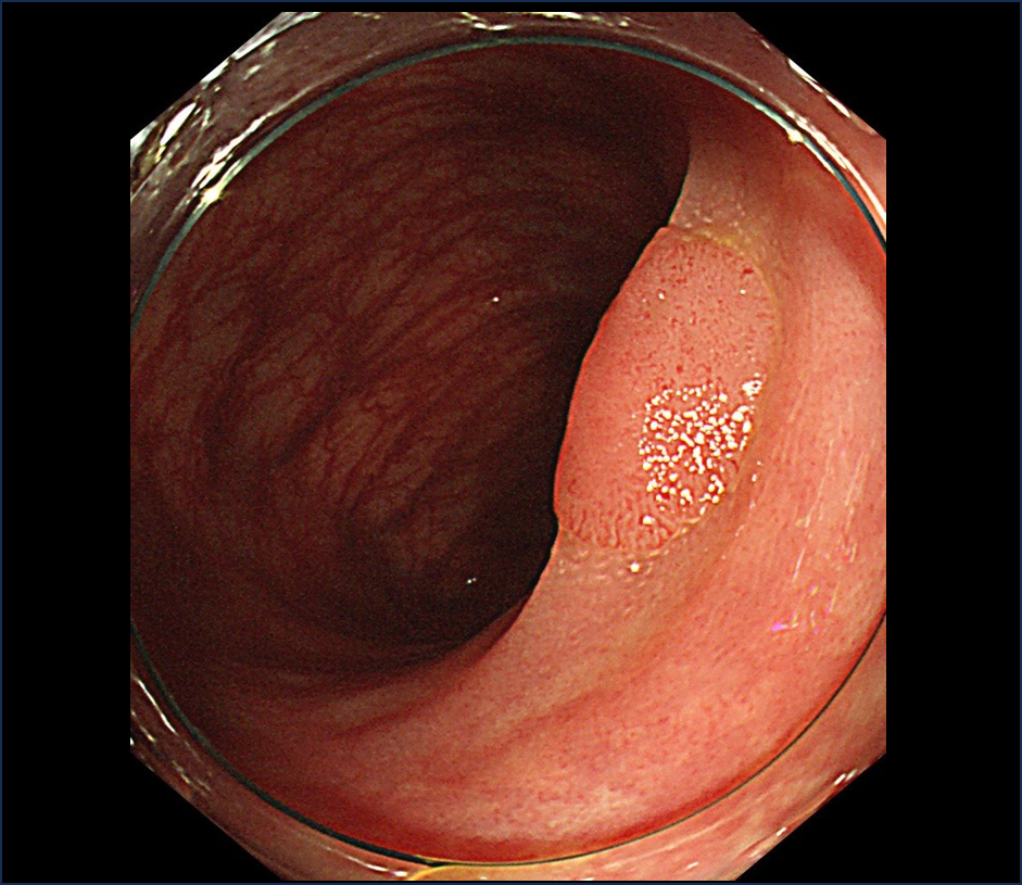 大腸ポリープ