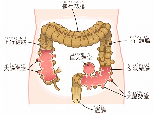憩室炎の定義と発症メカニズム