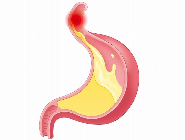 逆流性食道炎との関係
