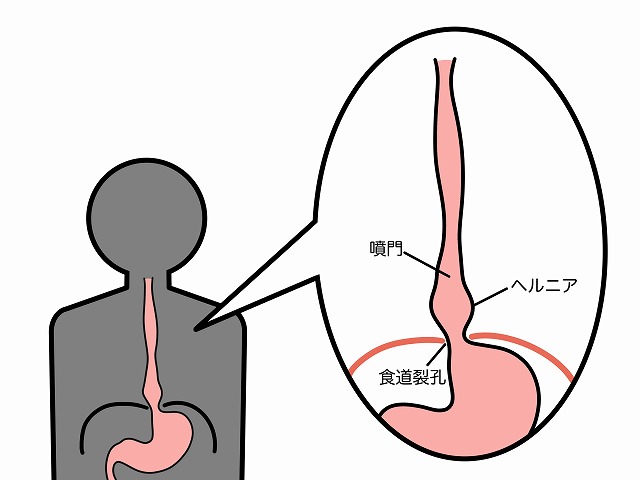 食道裂孔ヘルニアとは